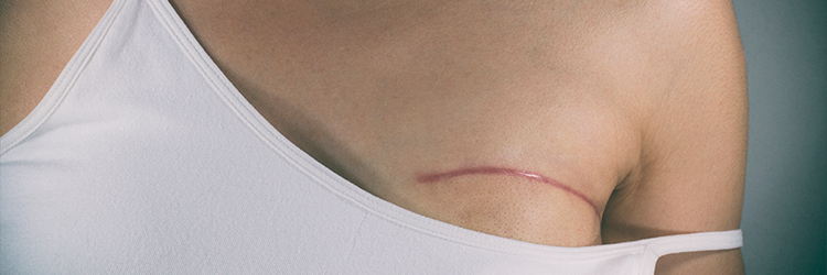 13 – Cirurgia de reconstrução mamária